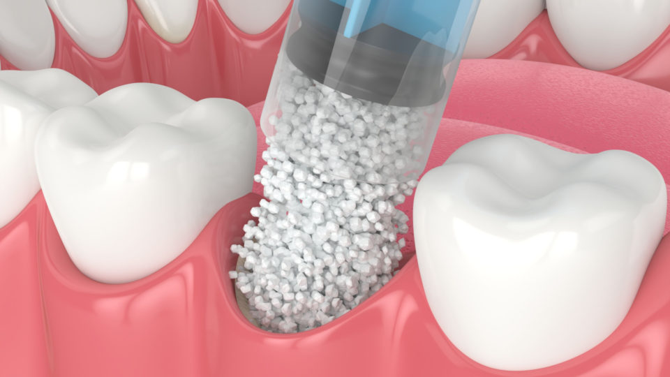 Enxerto ósseo dentário e suas complicações