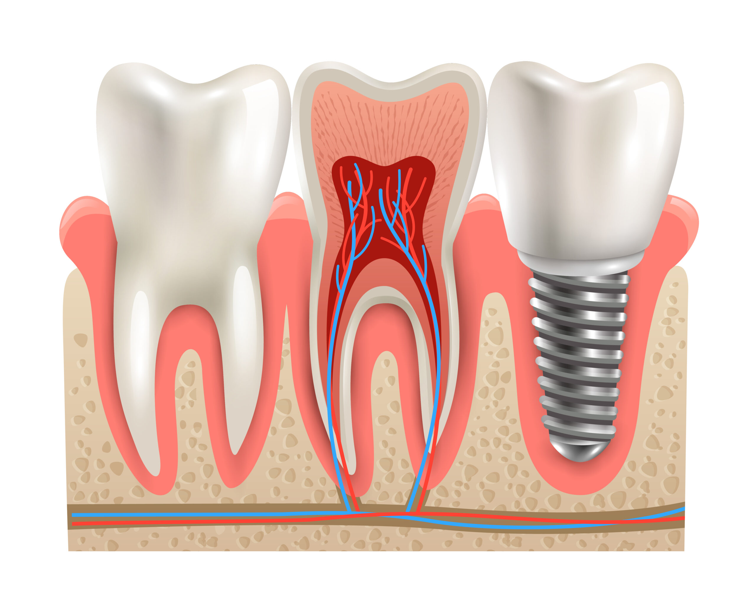 Benefícios do implante dentário: você conhece?
