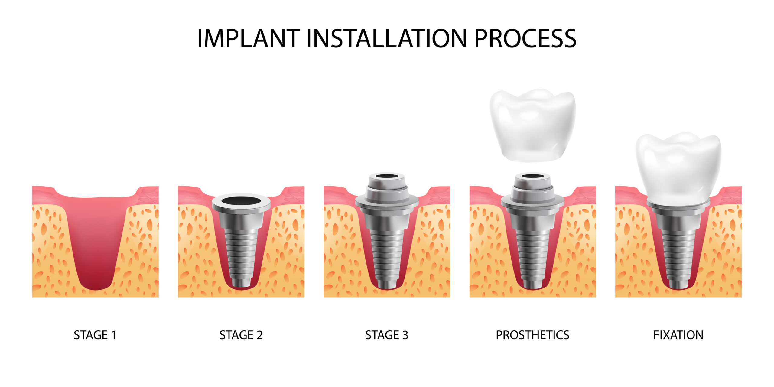 Processo de osseointegração do implante: como funciona?