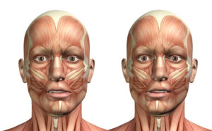 3d figura médica mostrando desvio lateral mandíbula