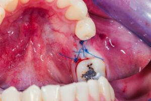 a gengiva é suturada com fio dental especial na incisão cirúrgica