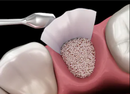 Tipos de enxerto ósseo dentário