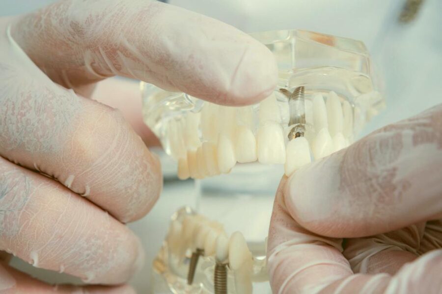 o ortodontista segura um mondelo de dentes com implante na mão e mostra como inserir o dente close-up-macro-everglow